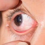 Allergische-Bindehautentzuendung