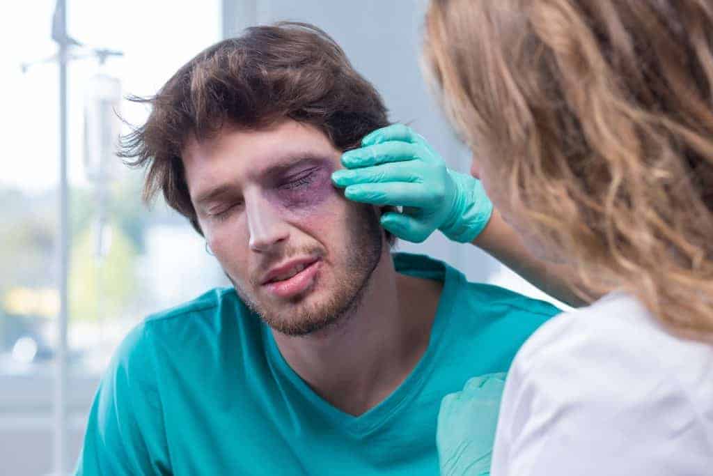 Augenverletzung-mit-Hämatom