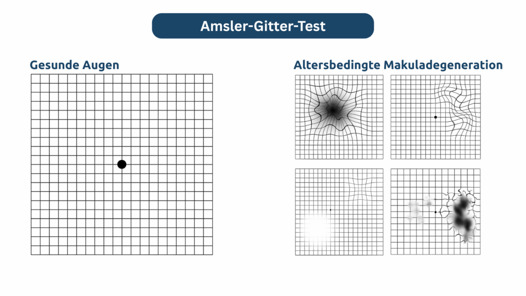 Ein Gittervergleich zeigt links ein regelmäßiges Quadratgitter mit schwarzem Punkt (gesunde Augen). Rechts fünf Gitter mit Verzerrungen oder Flecken (Makuladegeneration).