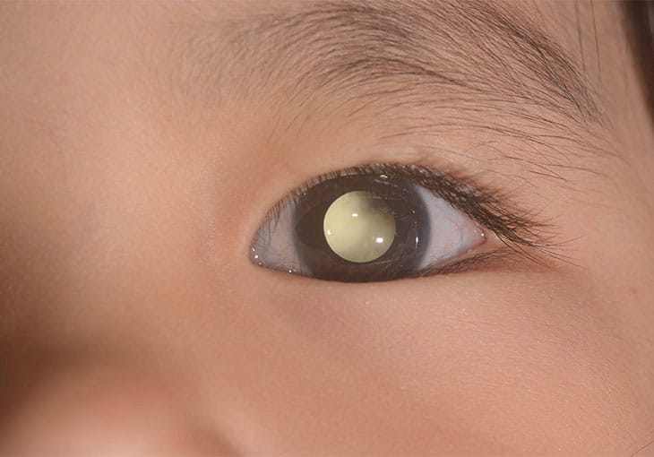 augenkrebs - retinoblastom